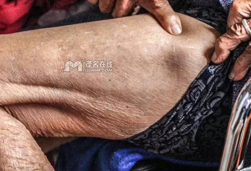 　　阿婆以前生活还是可以自理的，但左腿早年不慎摔倒，大腿需要植入钢钉。左腿的不便导致右腿在今年六月份也再次不慎摔倒，所以两脚行动不便需要人照顾。